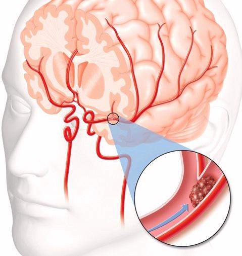 Blood Clot Brain Surgery